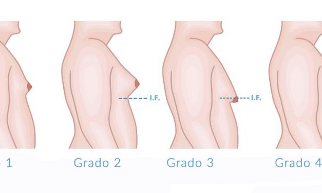 Ginecomastia – Riduzione seno maschile