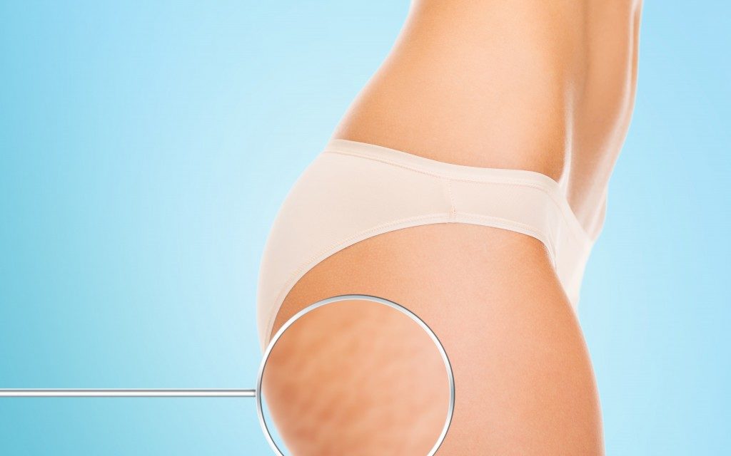 La cellulite, come combatterla?