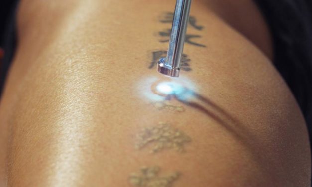 Cancellare un tatuaggio con la chirurgia estetica