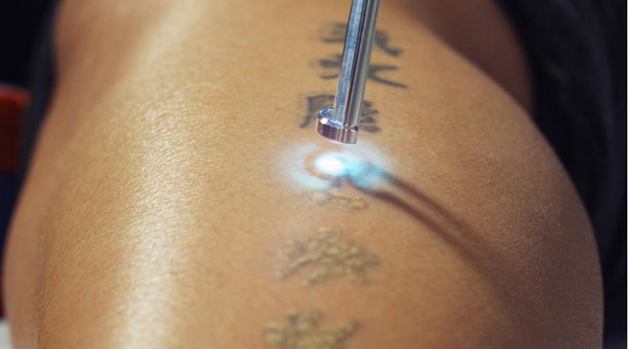Cancellare un tatuaggio con la chirurgia estetica